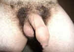 foreskin slit for phimosis cure - dorsal circumcision