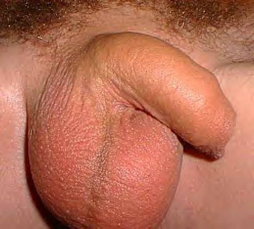 A typical flaccid penis uncircumcised and circumcised