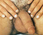 circumcision scar