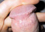 pearly penile papules