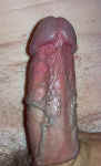 prominent veins on the penis