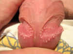 pearly penile papules