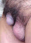 no penile shaft visible when not erect